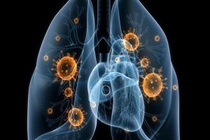  Phân loại viêm phổi theo tác nhân vi sinh